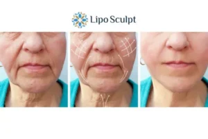 Explaining Morpheus8 And What It Can Do For You 3 Boost your confidence with Morpheus8 Bricket Wood call our team today!