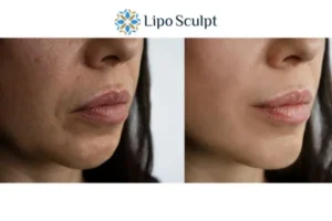Explaining Morpheus8 And What It Can Do For You 4 Morpheus8 Bricket Wood the best results - call our team today!
