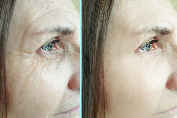 Why Do People Choose HIFU for a Non-Surgical Facelift? 4 How long can HIFU results last Bricket Wood?