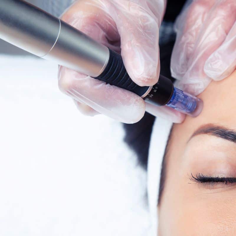 Morpheus8 treatment Bricket Wood from Lipo Sculpt - Book in today!